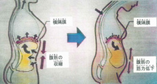 【腹圧】（左が正しい姿勢で、右が歪んだ姿勢）資料：日本テレビ放送『おもいッきりテレビ』より